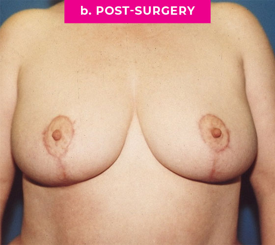 Breast Reconstruction Patient 6 After