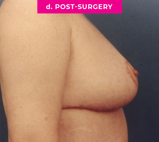 Breast Reconstruction Patient 6 After Side