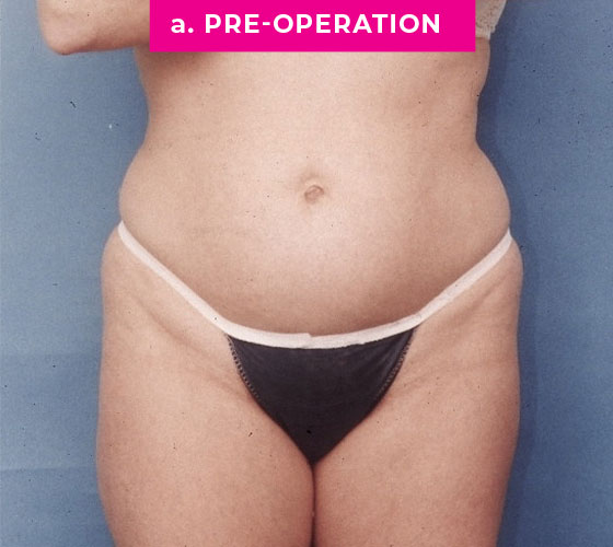 Liposuction Patient 1 Before
