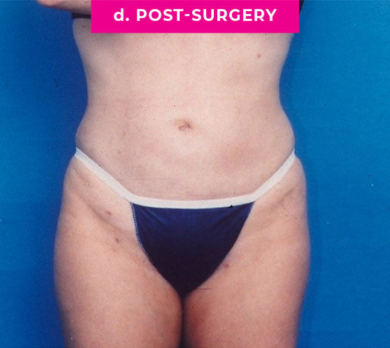 Liposuction Patient 1 After