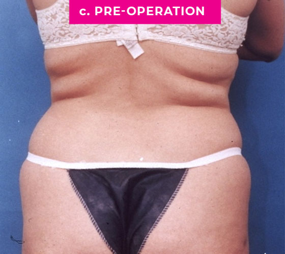 Liposuction Patient 1 Before Back