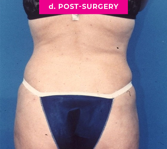 Liposuction Patient 1 After Back