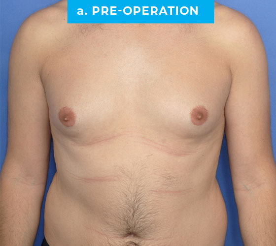 Liposuction Patient 2 Before