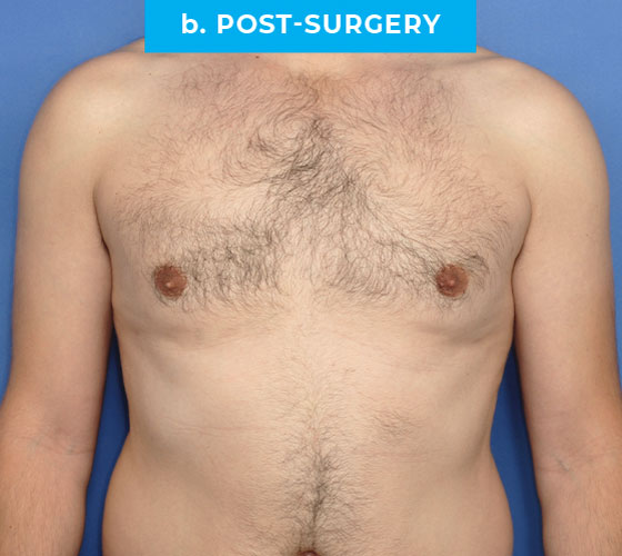 Liposuction Patient 2 After