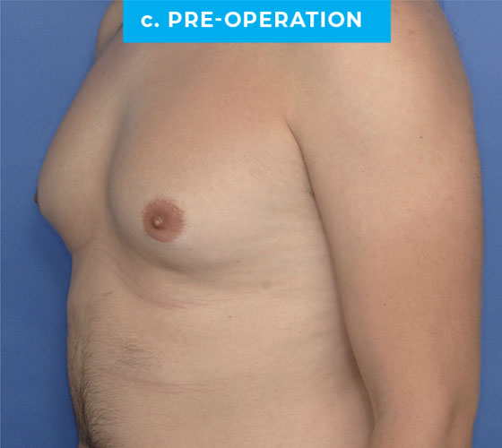 Liposuction Patient 2 Before Side