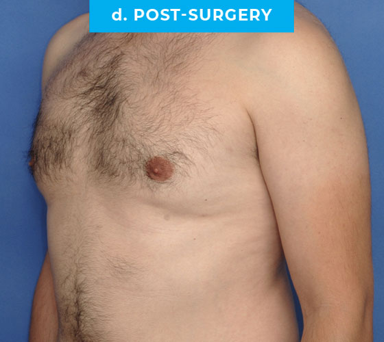 Liposuction Patient 2 After Side