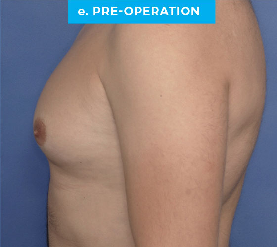 Liposuction Patient 2 Before 3