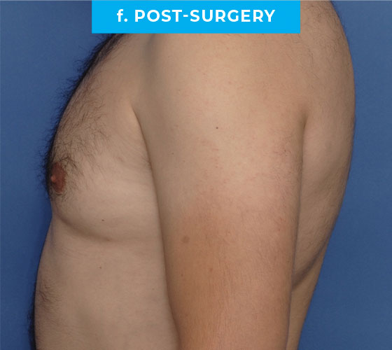 Liposuction Patient 2 After 3