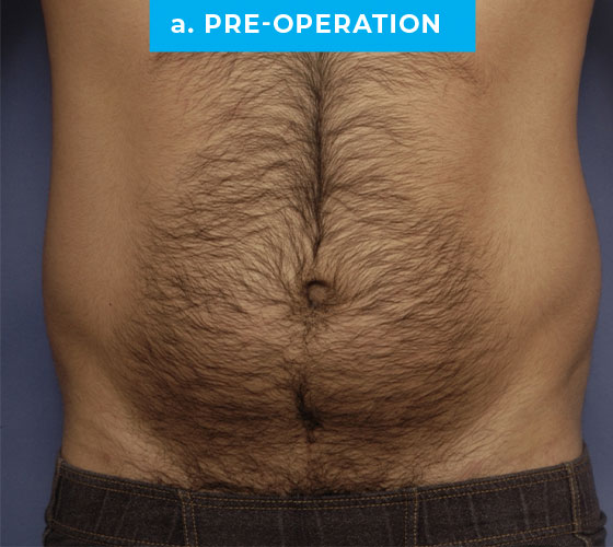 Liposuction Patient 3 Before