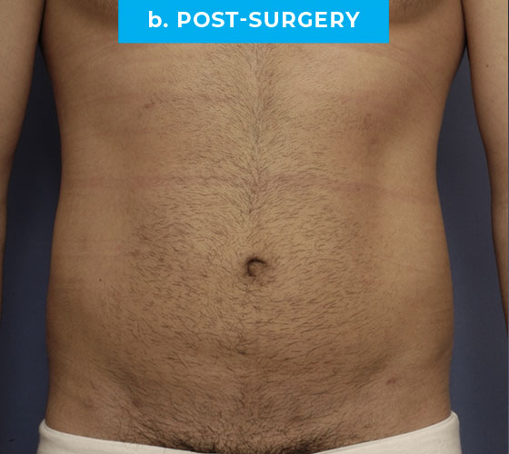 Liposuction Patient 3 After