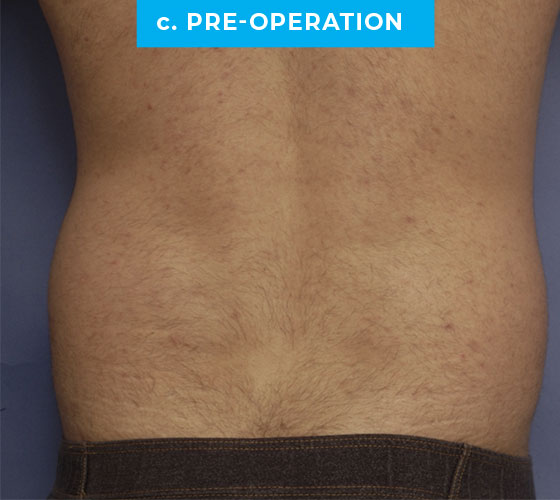 Liposuction Patient 3 Before Back