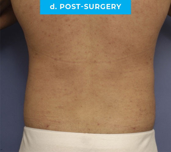 Liposuction Patient 3 After Back