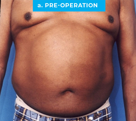 Liposuction Patient 4 Before