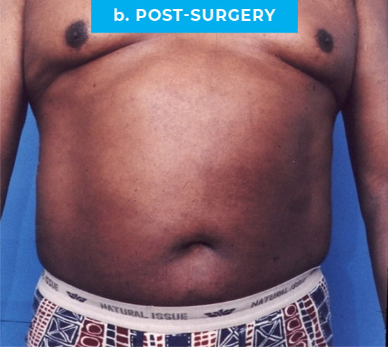 Liposuction Patient 4 After