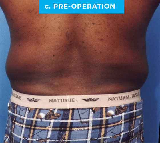 Liposuction Patient 4 Before Back