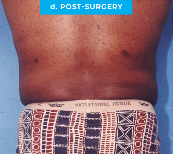 Liposuction Patient 4 After Back