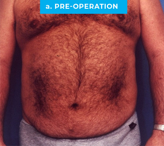 Liposuction Patient 5 Before