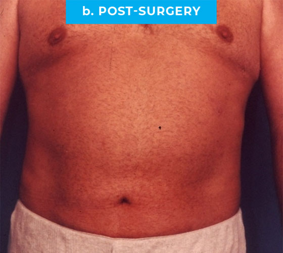 Liposuction Patient 5 After