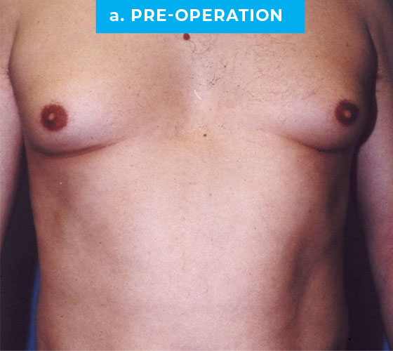 Liposuction Patient 6 Before