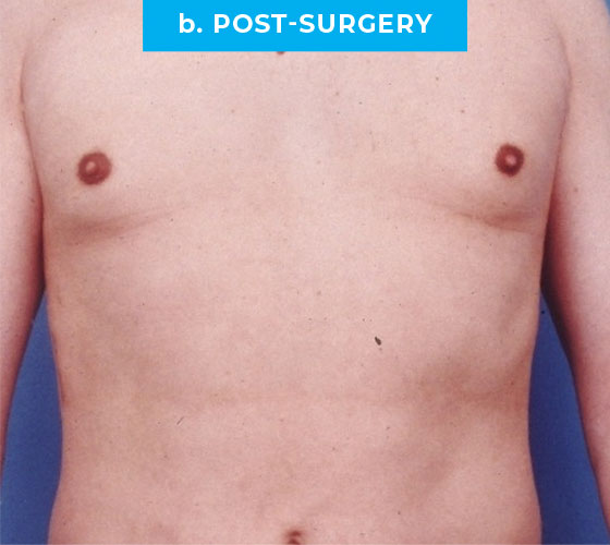 Liposuction Patient 6 After