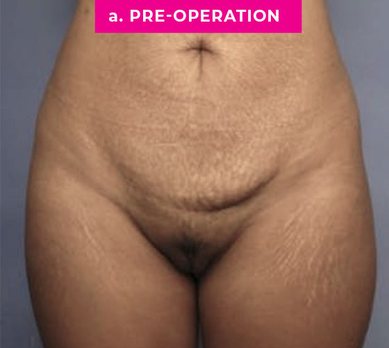 Abdominoplasty Patient 2 Before