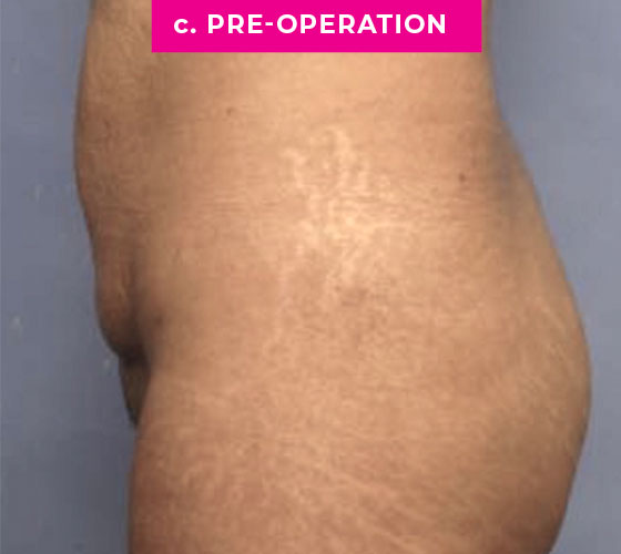 Abdominoplasty Patient 2 Before Side