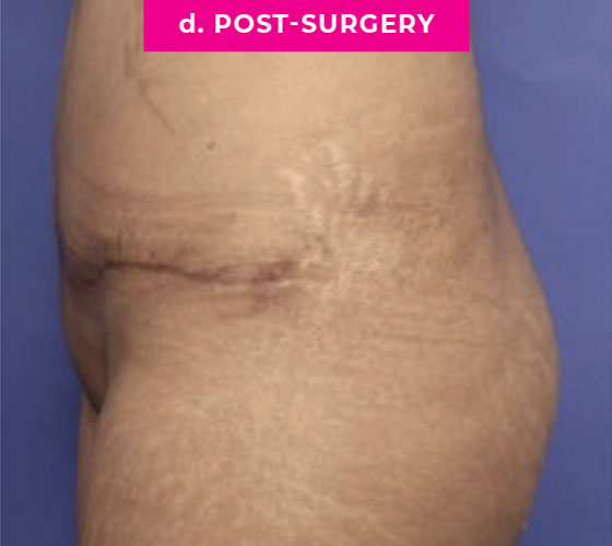 Abdominoplasty Patient 2 After Side
