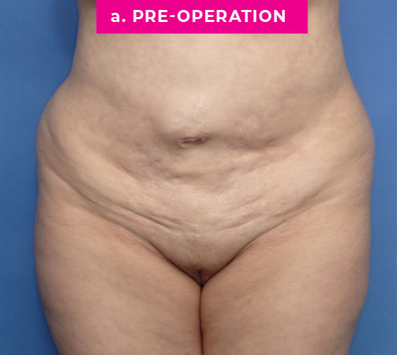 Abdominoplasty Patient 3 Before
