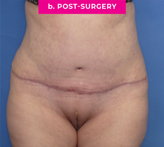 Abdominoplasty Patient 3 After