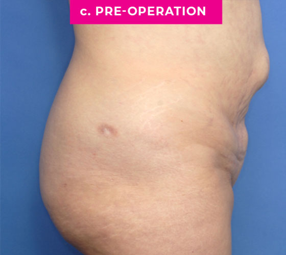 Abdominoplasty Patient 3 Before Side
