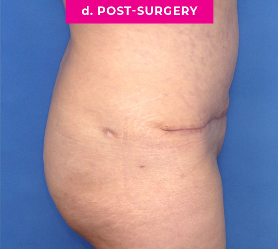 Abdominoplasty Patient 3 After Side