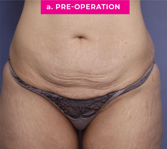 Abdominoplasty Patient 5 Before