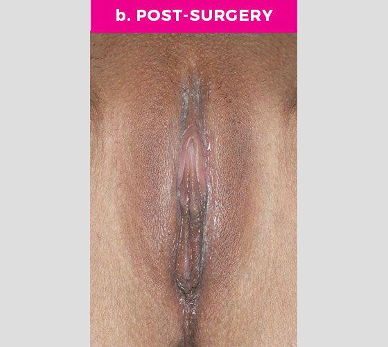 CLITORAL HOOD REDUCTION WITH/WITHOUT CLITOROPEXY Patient 10 After
