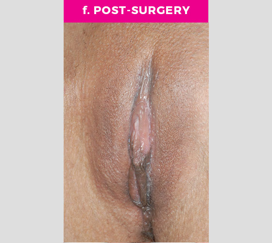 CLITORAL HOOD REDUCTION WITH/WITHOUT CLITOROPEXY Patient 10 After 3