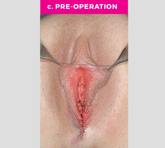 CLITORAL HOOD REDUCTION WITH/WITHOUT CLITOROPEXY Patient 11 Before 2