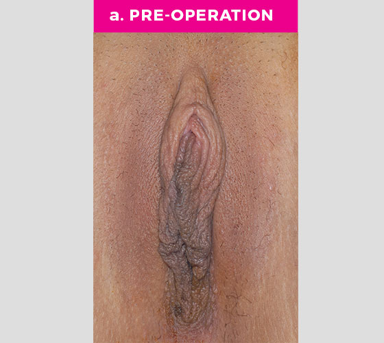 CLITORAL HOOD REDUCTION WITH/WITHOUT CLITOROPEXY Patient 12 Before