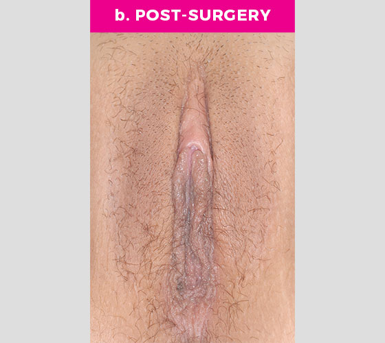 CLITORAL HOOD REDUCTION WITH/WITHOUT CLITOROPEXY Patient 12 After