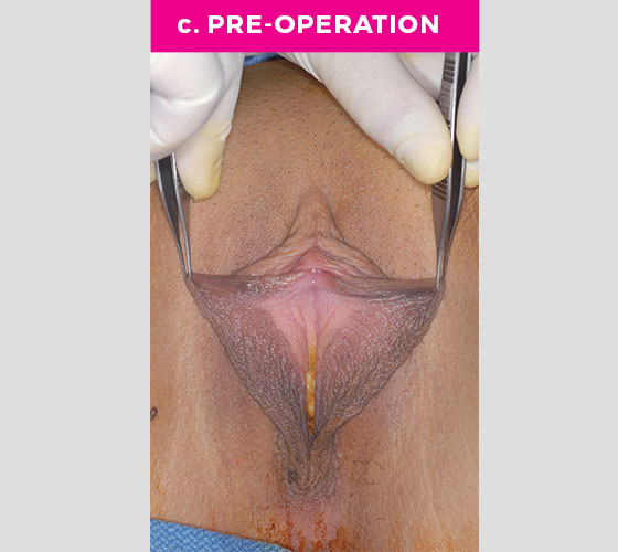 CLITORAL HOOD REDUCTION WITH/WITHOUT CLITOROPEXY Patient 12 Before 2