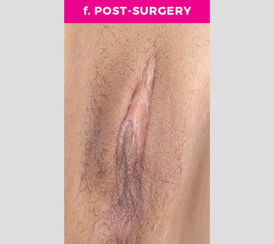 CLITORAL HOOD REDUCTION WITH/WITHOUT CLITOROPEXY Patient 12 After 3