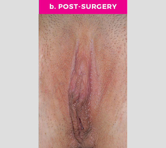 CLITORAL HOOD REDUCTION WITH/WITHOUT CLITOROPEXY Patient 15 After