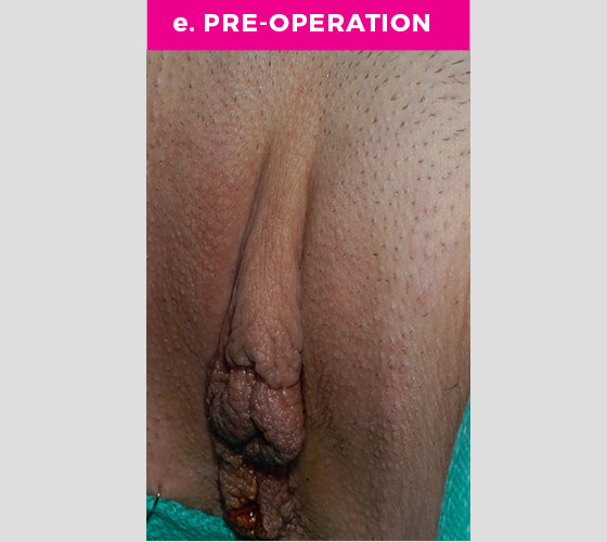 CLITORAL HOOD REDUCTION WITH/WITHOUT CLITOROPEXY Patient 15 Before 3