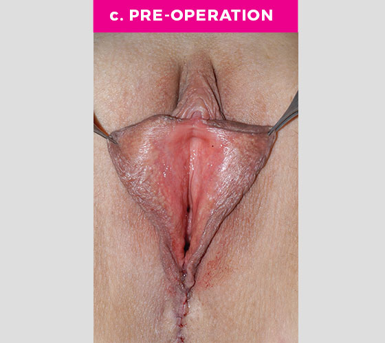 CLITORAL HOOD REDUCTION WITH/WITHOUT CLITOROPEXY Patient 15 Before 2