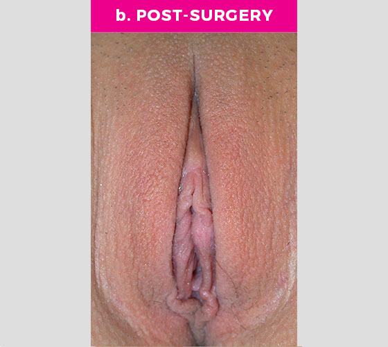 CLITORAL HOOD REDUCTION WITH/WITHOUT CLITOROPEXY Patient 1 After