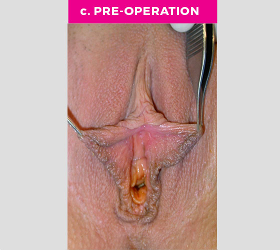 CLITORAL HOOD REDUCTION WITH/WITHOUT CLITOROPEXY Patient 1 Before 2