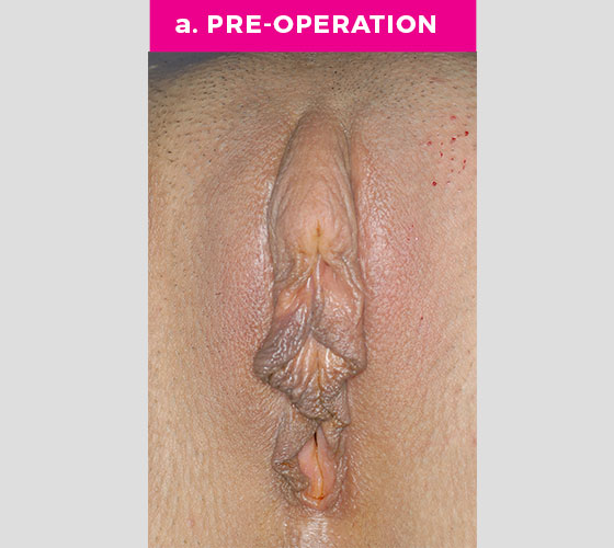 CLITORAL HOOD REDUCTION WITH/WITHOUT CLITOROPEXY Patient 3 Before