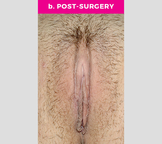 CLITORAL HOOD REDUCTION WITH/WITHOUT CLITOROPEXY Patient 3 After