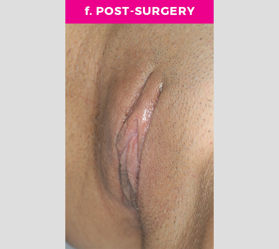 CLITORAL HOOD REDUCTION WITH/WITHOUT CLITOROPEXY Patient 3 After 3