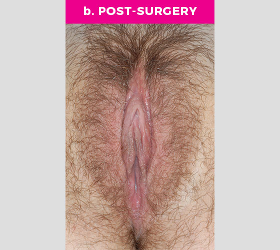 CLITORAL HOOD REDUCTION WITH/WITHOUT CLITOROPEXY Patient 4 After