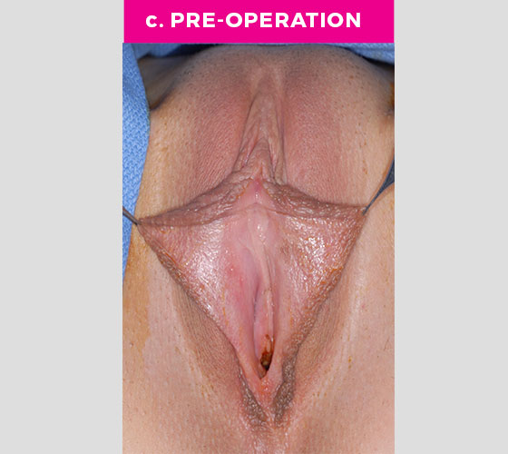 CLITORAL HOOD REDUCTION WITH/WITHOUT CLITOROPEXY Patient 4 Before 2