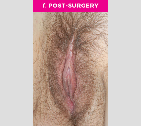 CLITORAL HOOD REDUCTION WITH/WITHOUT CLITOROPEXY Patient 4 After 3